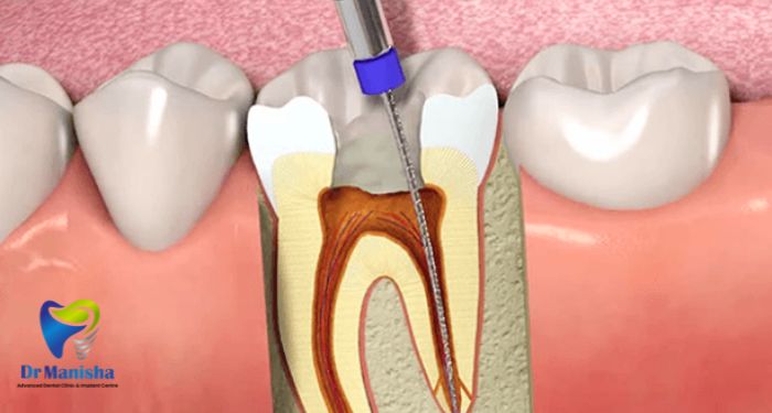 Visit Dr. Manisha Advanced Dental Clinic—your trusted dentist in Pimpri-Chinchwad for painless root canals, teeth braces, dental implants & smile makeovers.
