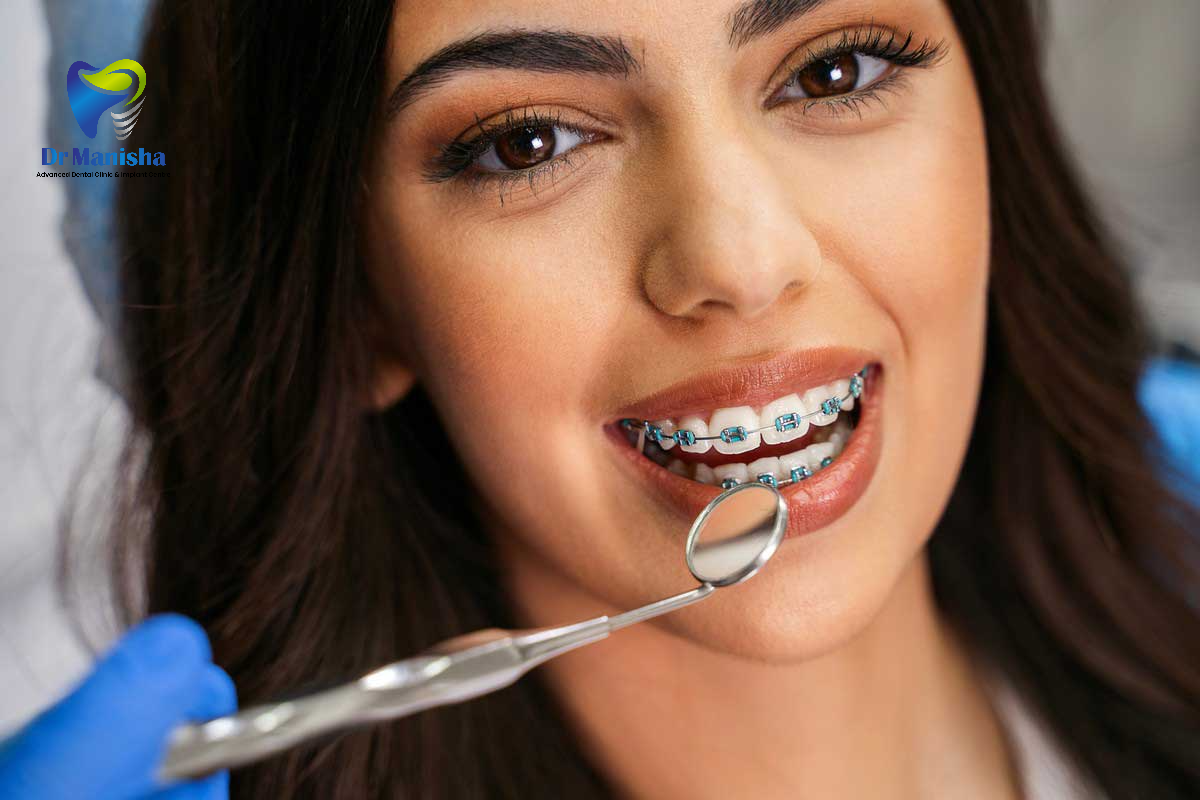 Braces, Types of Braces, Orthodontist, Metal Braces, Ceramic Braces, Invisalign, Clear Aligners, Teeth Straightening, Braces for Adults, Kids Braces, Dental Braces Guide, Orthodontic Treatment, Braces Benefits