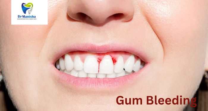 Stop the Bleed: Understanding Gum Bleeding and How to Treat It