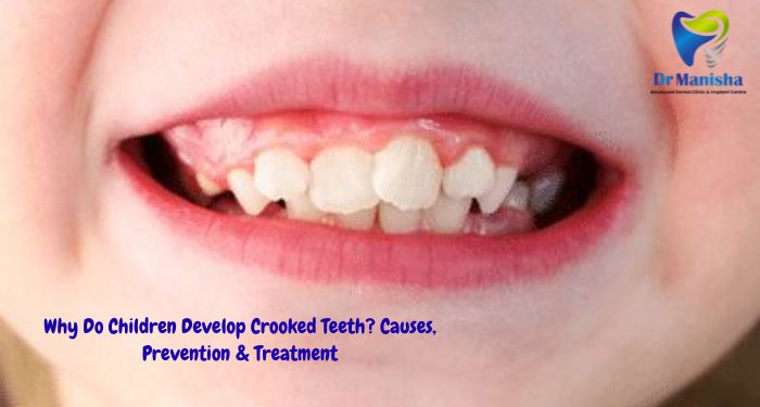 Why Do Children Develop Crooked Teeth? Causes, Prevention & Treatment