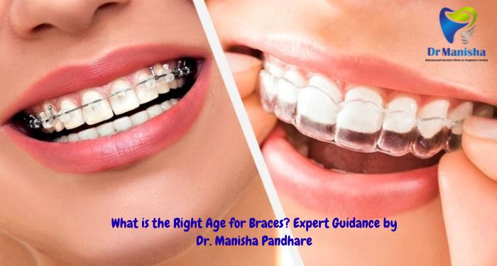 What is the Right Age for Braces? Expert Guidance by Dr. Manisha Pandhare
