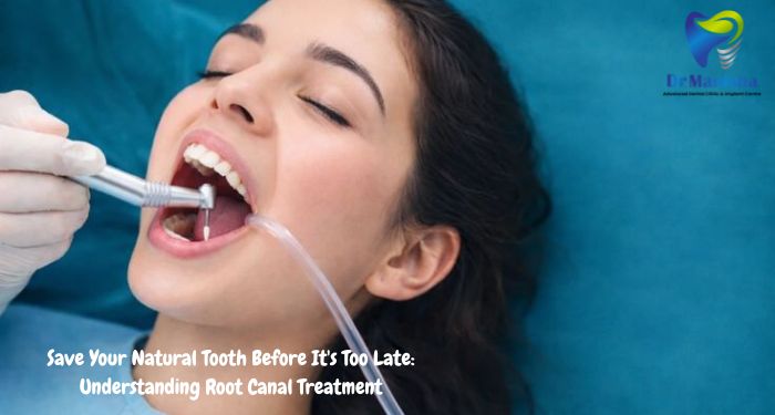 Save Your Natural Tooth Before It’s Too Late: Understanding Root Canal Treatment