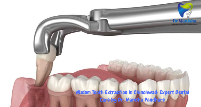 Wisdom Tooth Extraction: Expert Dental Care by Dr. Manisha Pandhare