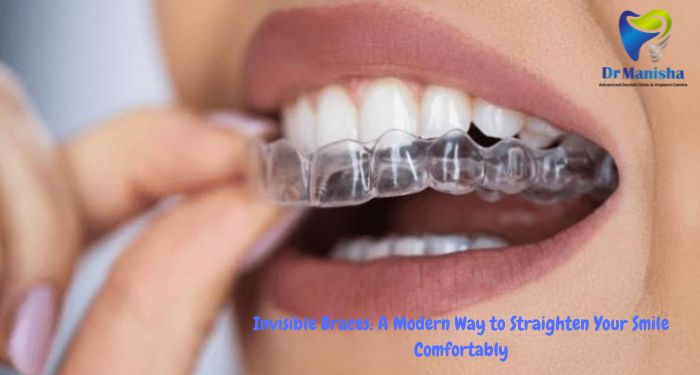 Invisible Braces: A Modern Way to Straighten Your Smile Comfortably