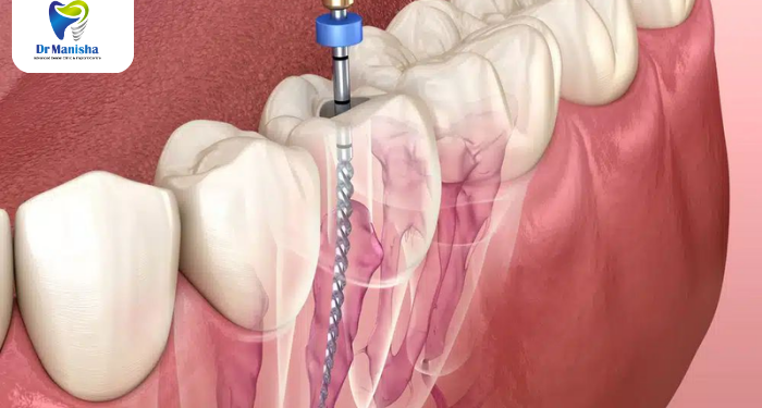 Painless Root Canal Treatment in Chinchwad: A Complete Guide to Comfortable Dental Care