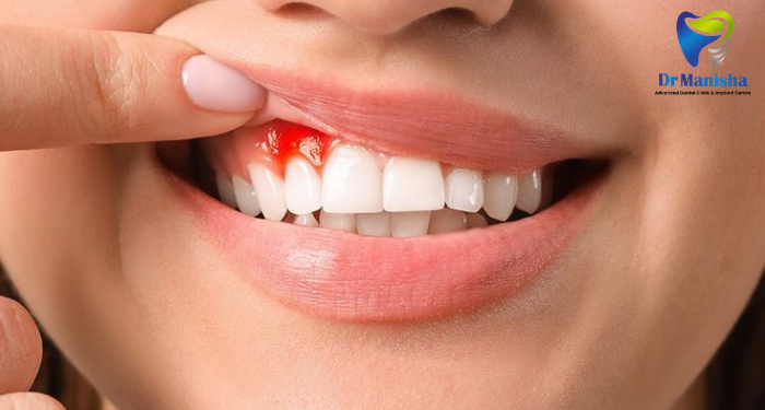 Bleeding Gums: Common Symptoms, Causes, and When to Visit a Dentist