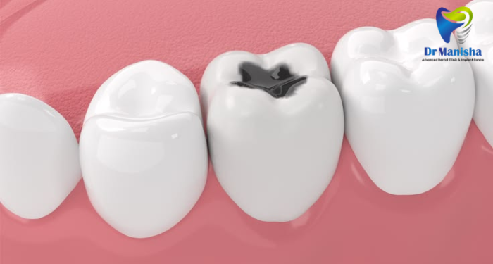 Cement Feeling in Teeth? Understand the Causes, Symptoms and Treatment Options